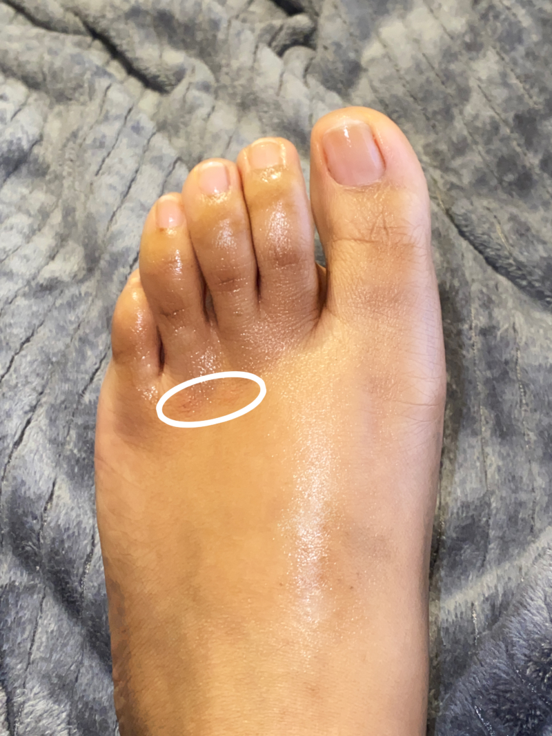 Deandrea Coco Wright's foot after applying coconut oil to ant bites