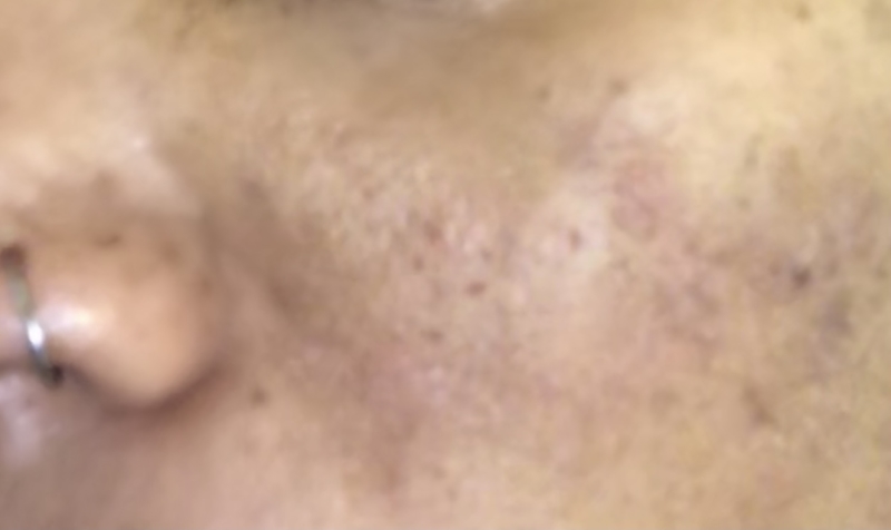 eczema flareup on black/african american skin